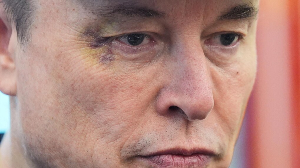 Elon Musk's black-eye: Truth behind the billionaire's bruised eye during Oval Office farewell